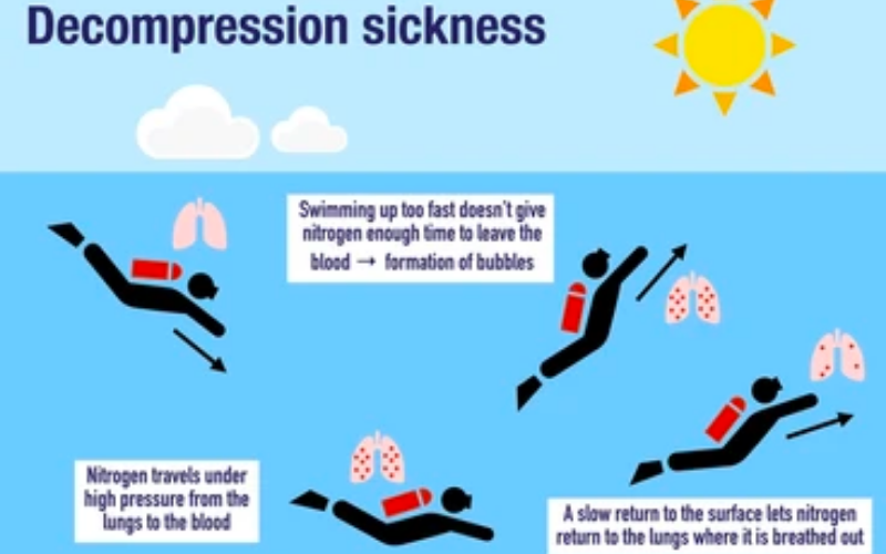 Decompression Sickness
